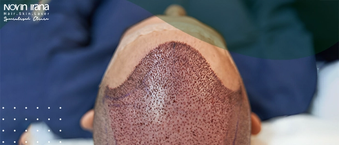 کاشت مو به روش sut